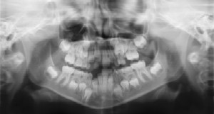 Dental Radiographs (X-Rays) - Pediatric Dentist in Fargo, ND